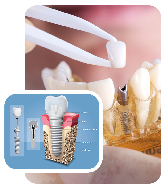 Restorative Dentistry Prince Rupert - Implants