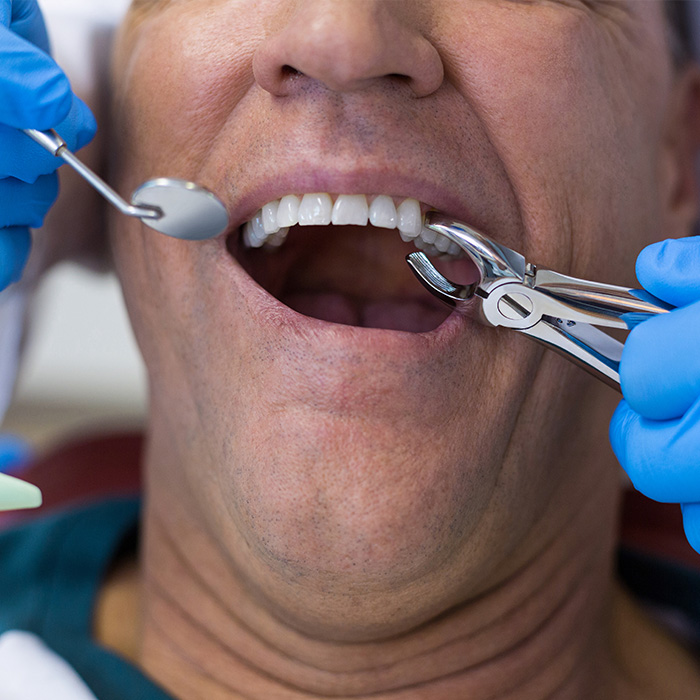 Wisdom Teeth extraction Prince Rupert