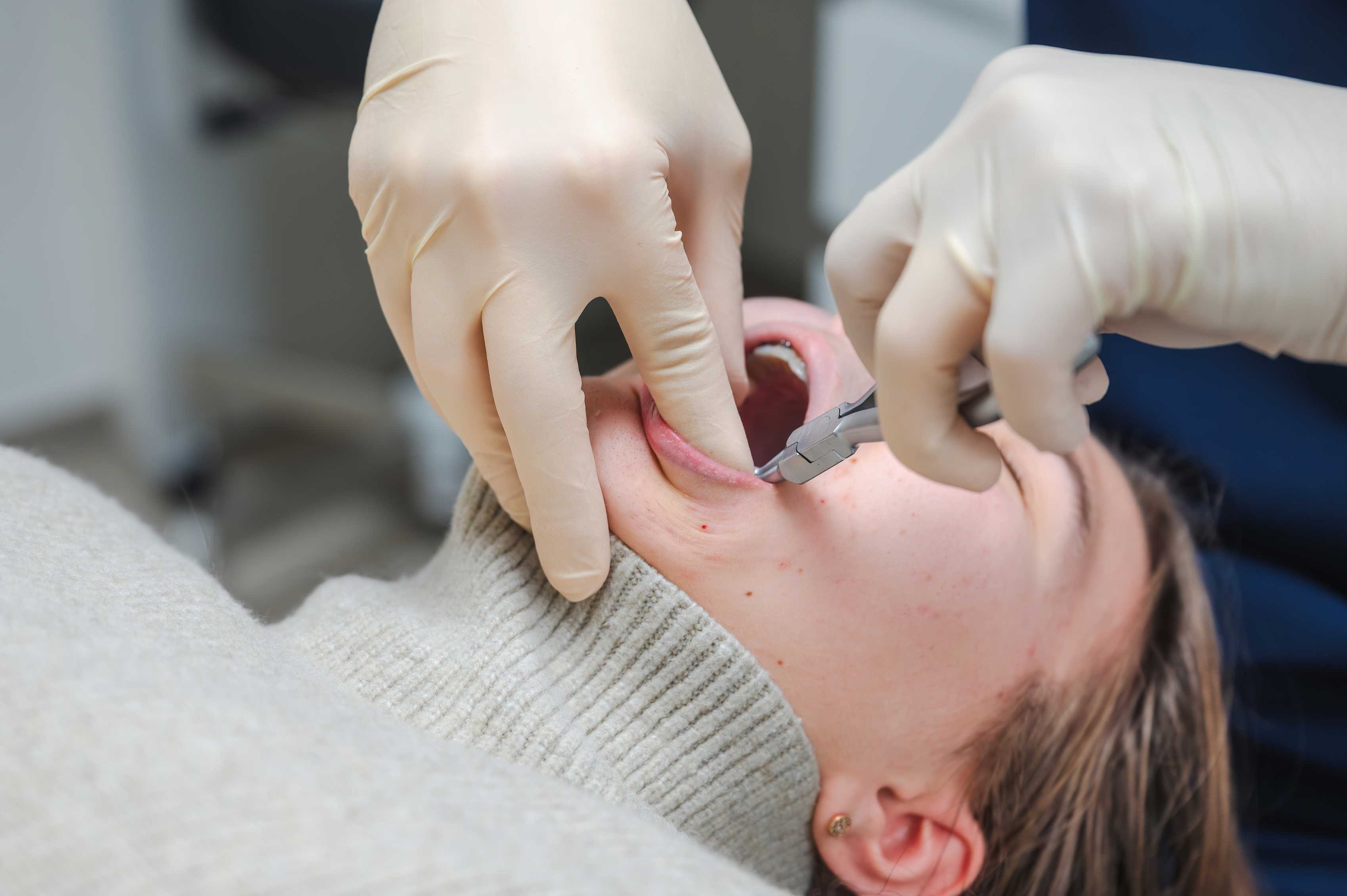 Routine tooth removal at Greenwoods Dental